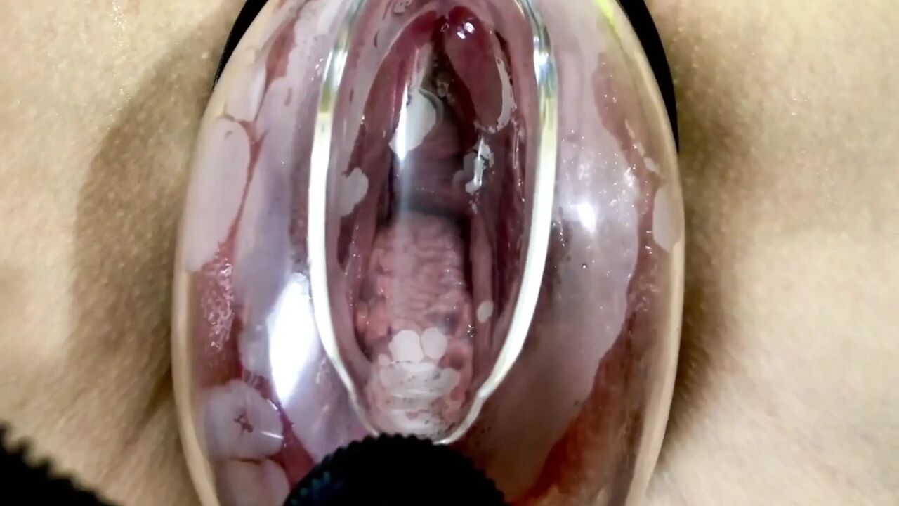 Vaginal Deformation Under the Influence of a Vacuum Pump